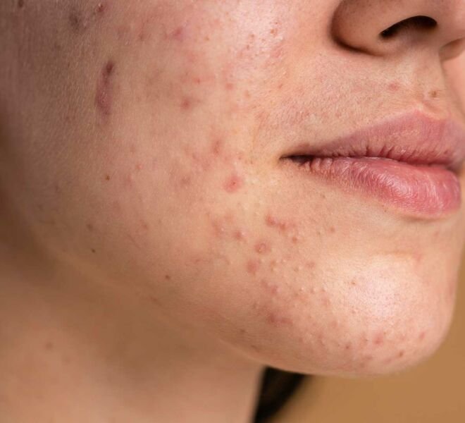 Acne dra samara berbert dermatologista