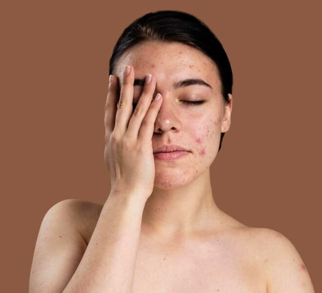 Acne dra samara berbert dermatologista