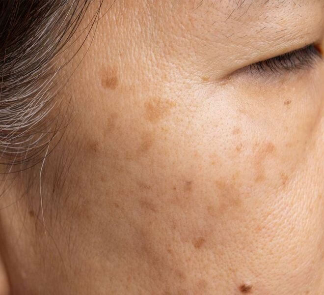 Melasma dra samara berbert dermatologista