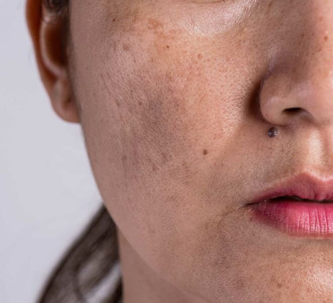 Melasma dra samara berbert dermatologista