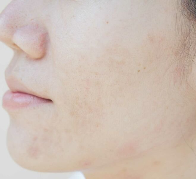 Melasma dra samara berbert dermatologista