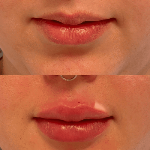 Preenchimento labial Samara Berbert1