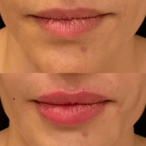 Preenchimento labial Samara Berbert2