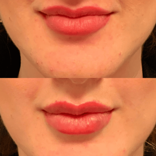 Preenchimento labial Samara Berbert3