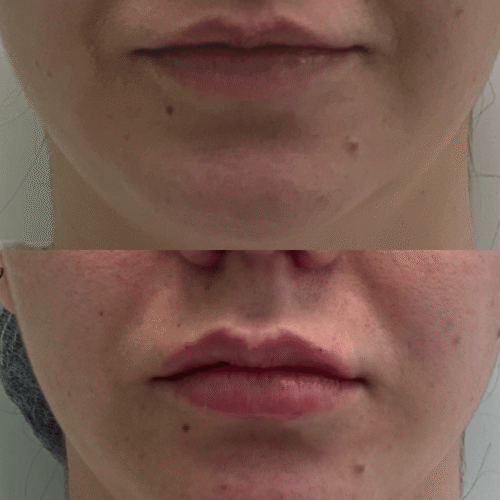 Preenchimento labial Samara Berbert4