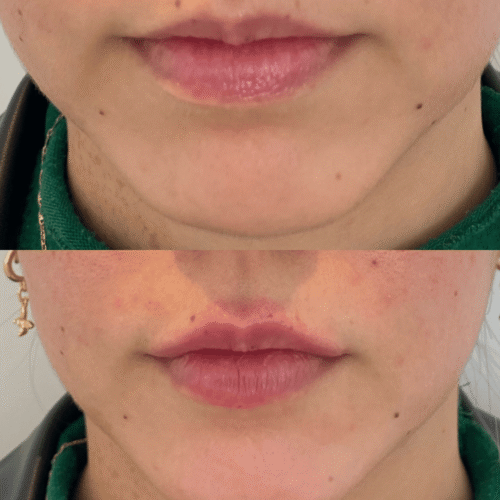 Preenchimento labial Samara Berbert6