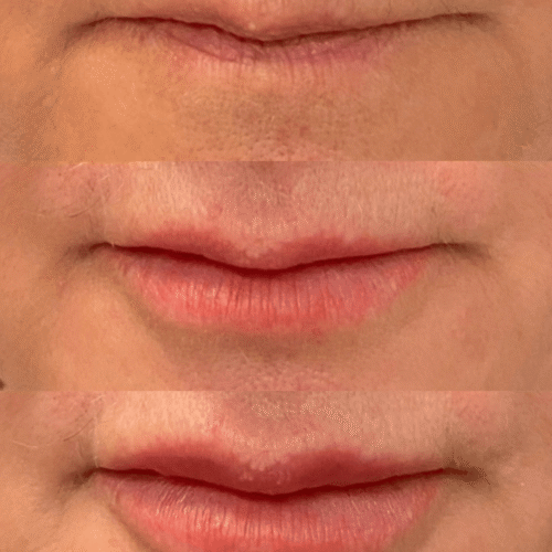 Preenchimento labial Samara Berbert7